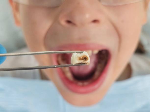 Best Emergency Dentist for Lost Fillings or Crowns in Cridersville, OH